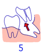 親知らずの抜き方５